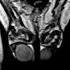 МРТ наружных половых органов у мужчин