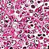 Гистология биоптата слизистой лор-органов